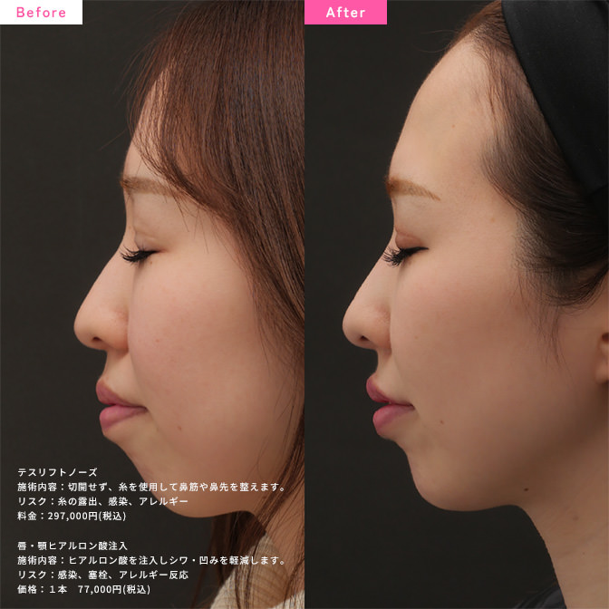 鼻背（鼻を高く）、鼻尖形成 切らない鼻整形 TESSLIFT NOSE