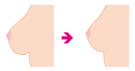 乳房縮小術