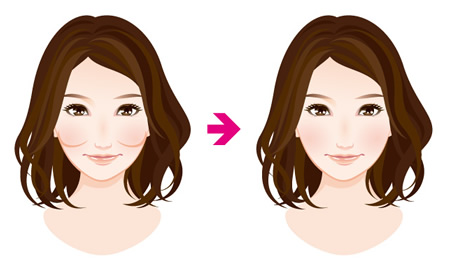 頬骨削り