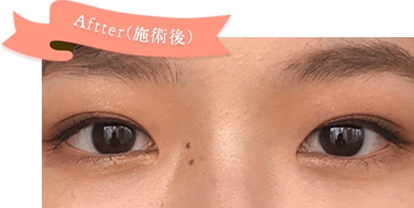 Aftter(施術後)