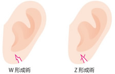 耳垂裂形成術