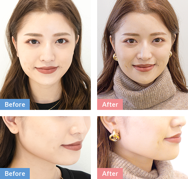 BeforeAfter