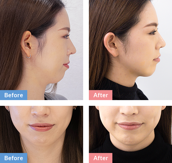 BeforeAfter