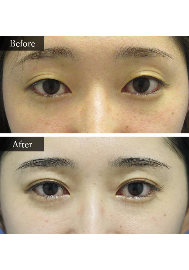 二重埋没法　症例