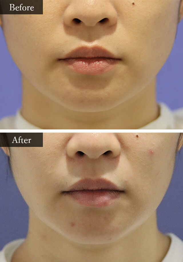 エラボトックス　症例