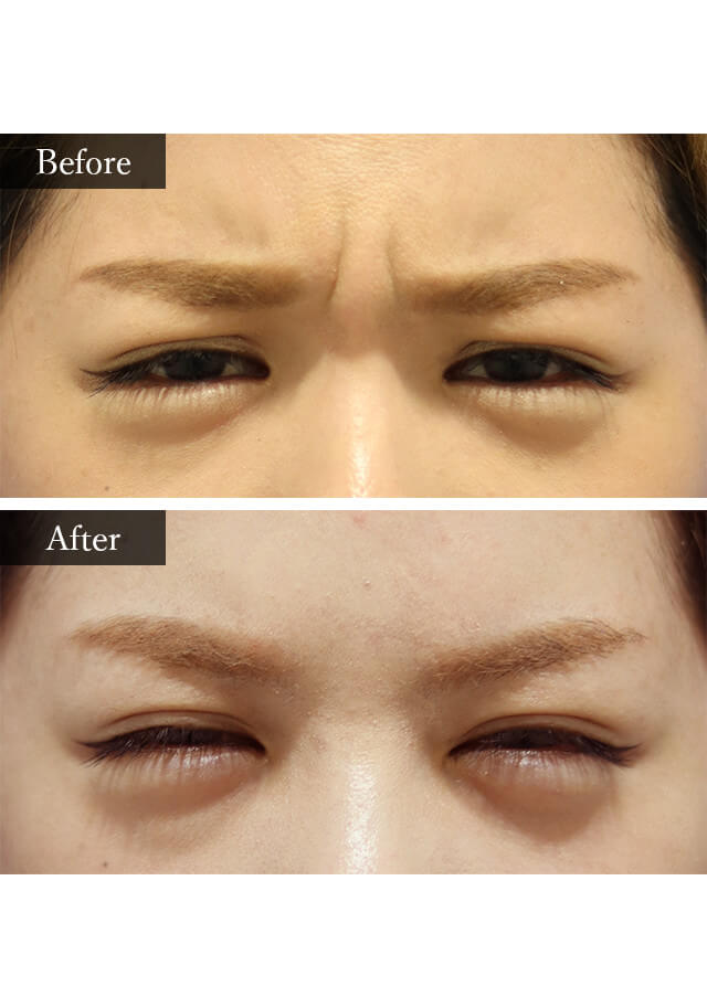 眉間ボトックス　症例