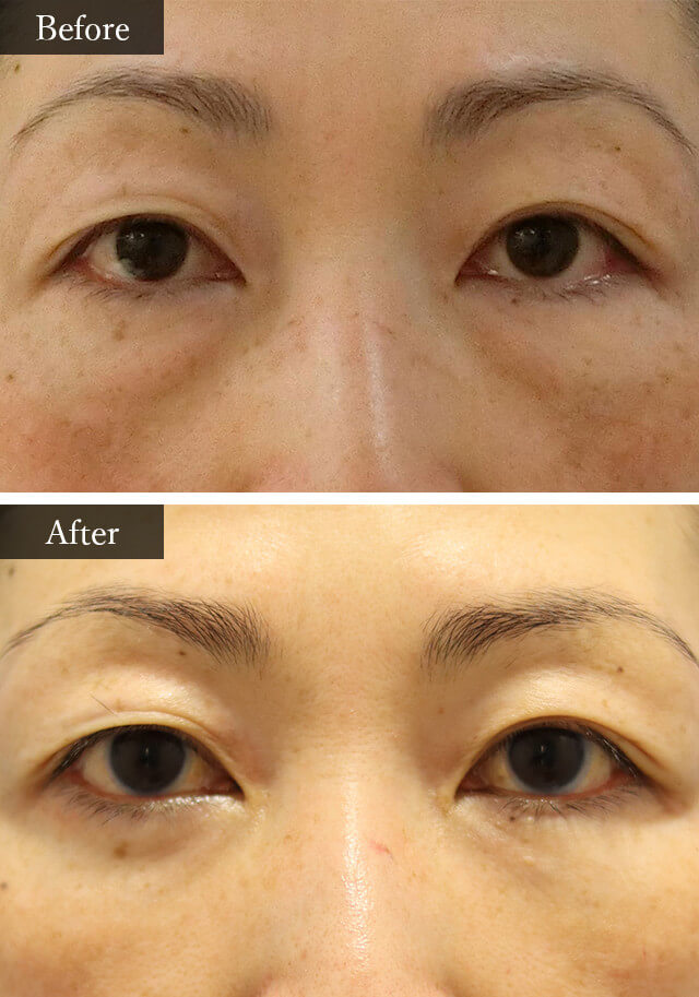 目の下のクマ・たるみ治療　症例