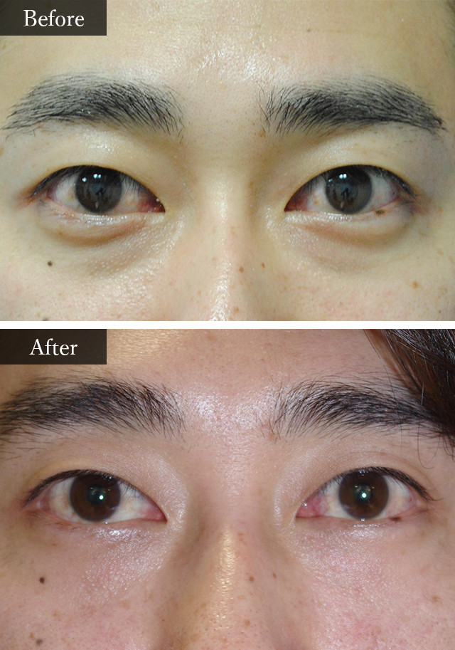 目の下のクマ・たるみ治療　症例