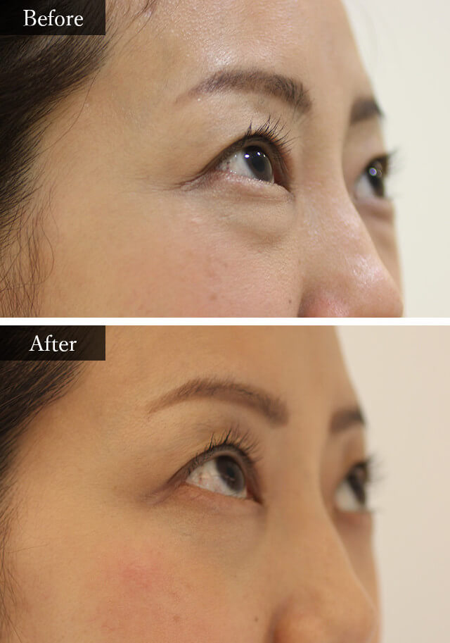 目の下のクマ・たるみ治療　症例