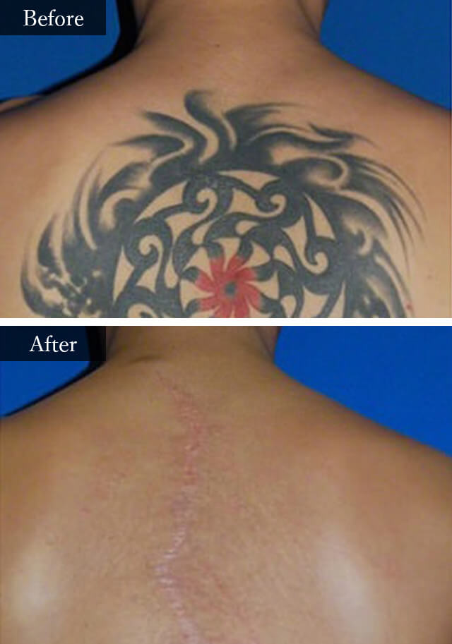 タトゥー切除　症例