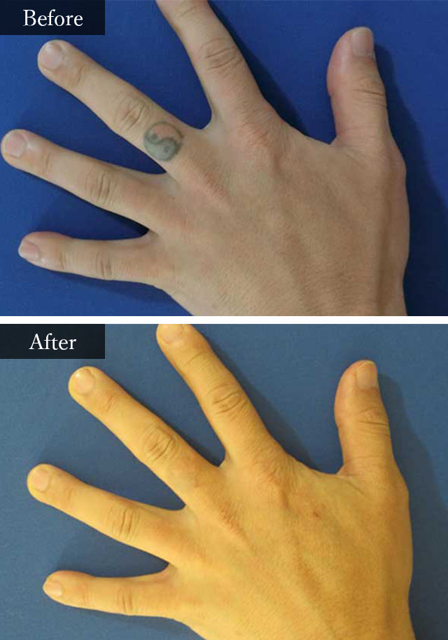 タトゥーPICOレーザー　症例