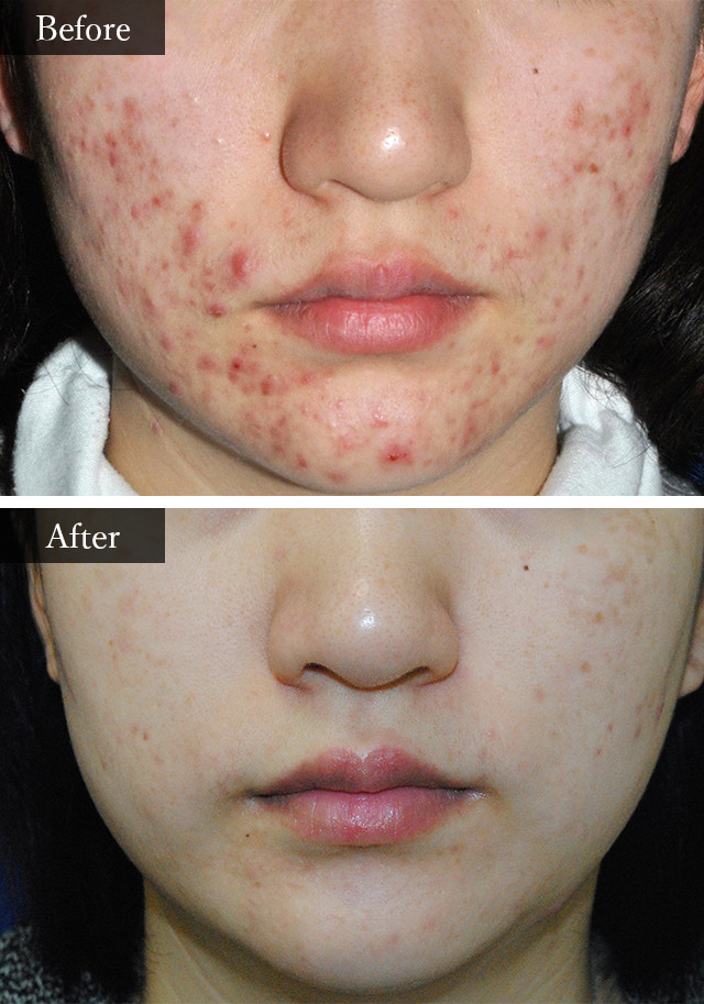 ニキビ・ニキビ跡治療　症例