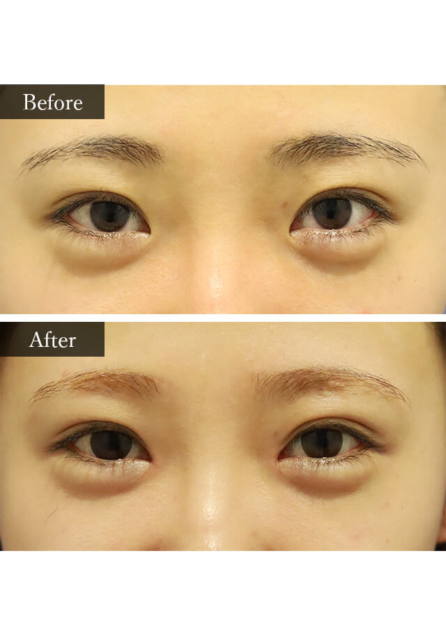 目頭切開　症例