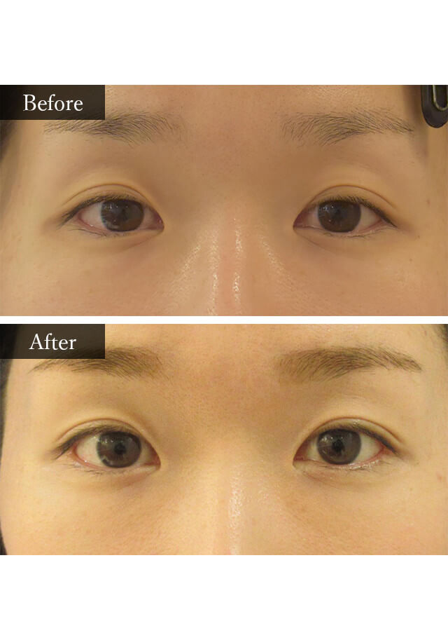 目尻切開　症例