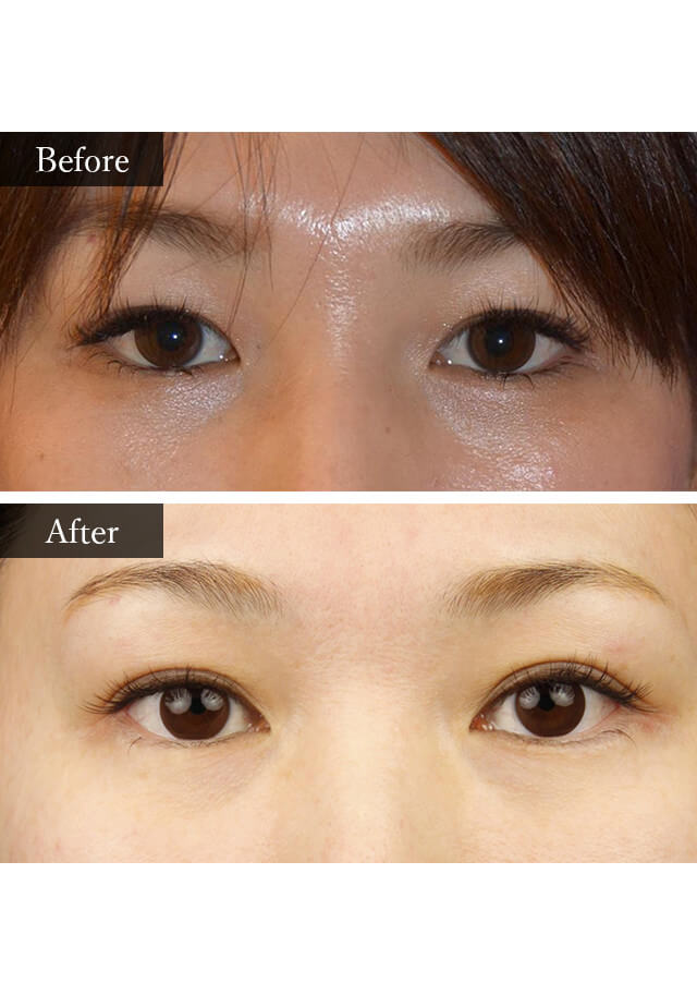 たれ目形成　症例