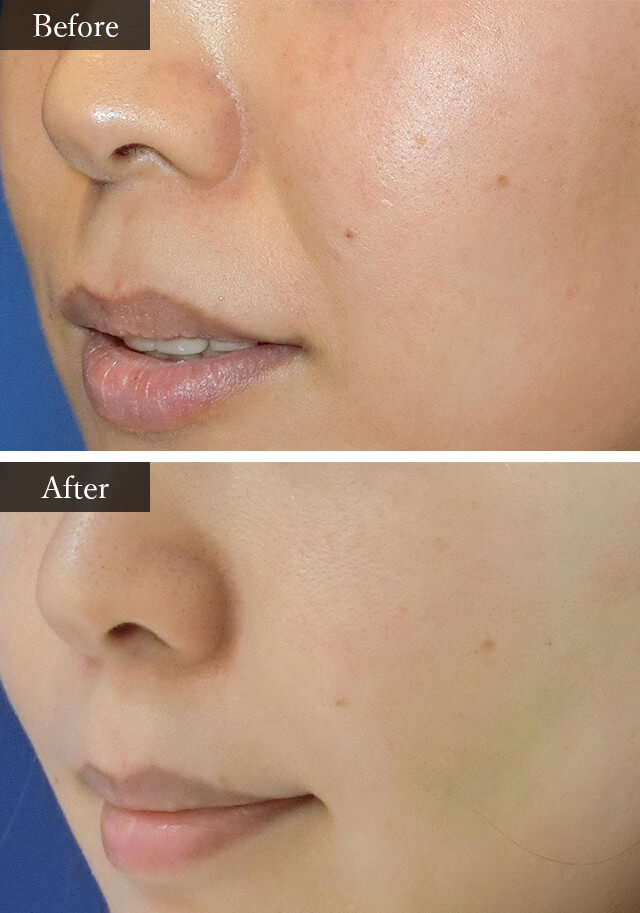 ほうれい線改善　症例