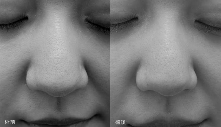 術後 術前