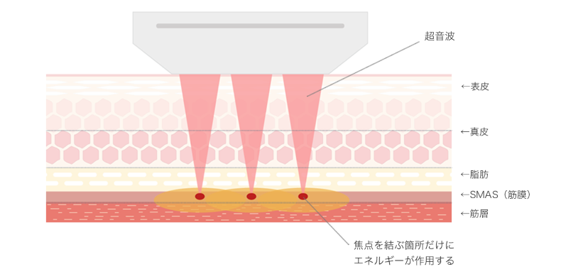【4.5mm・3.0mm】のトランスデューサー 超音波 表皮 真皮 脂肪 SMAS(筋膜) 筋層 焦点を結ぶ箇所だけにエネルギーが作用する