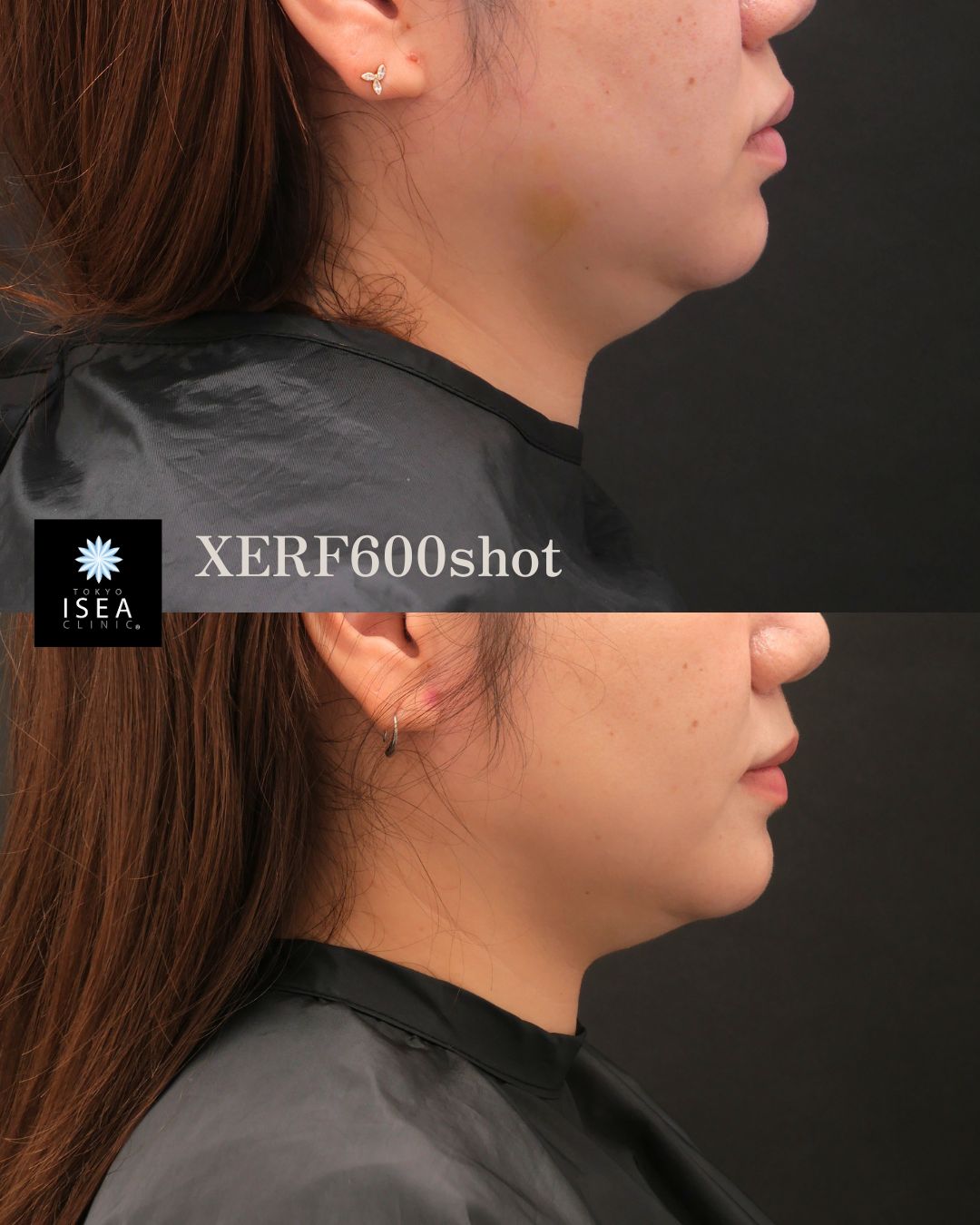 XERF(ザーフ)の症例写真 XERF600shot