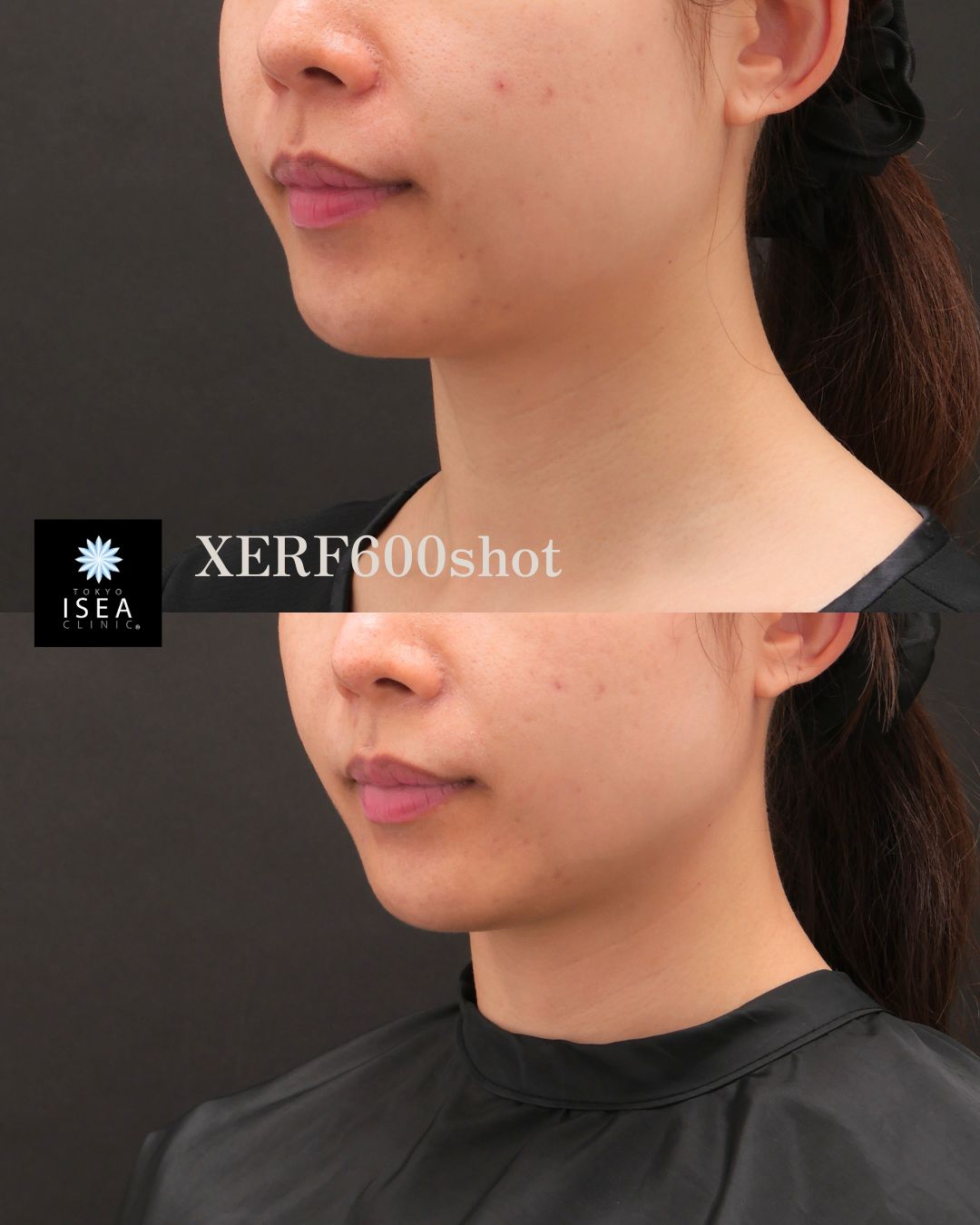 XERF(ザーフ)の症例写真 XERF600shot