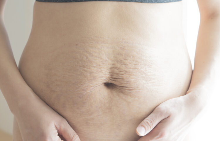 <strong>肉割れの治し方とは？自力・レーザーなど方法を解説</strong>