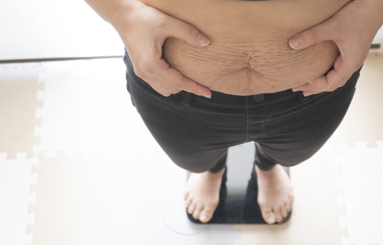 <strong>太ももの肉割れとは？付け根にできる白い線の原因と治し方</strong>