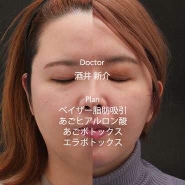顔の脂肪吸引 その他の症例写真