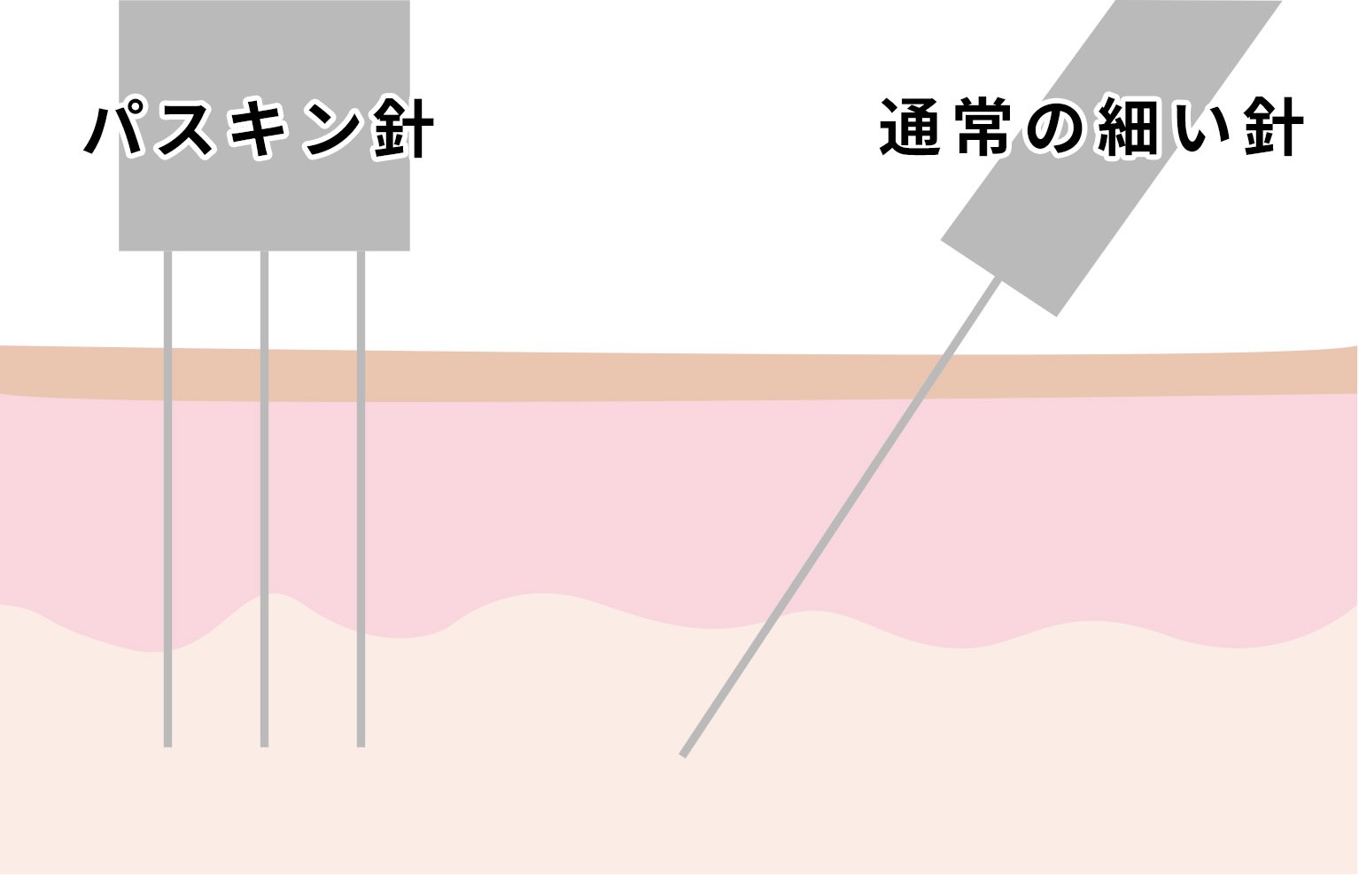 注射針 パスキン針 通常の細い針