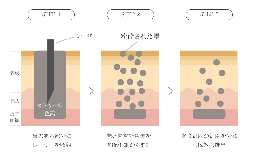 レーザー治療