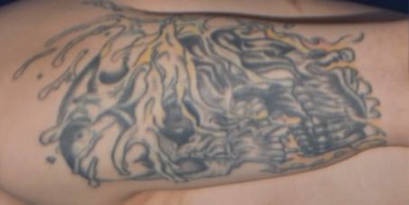 切除法before