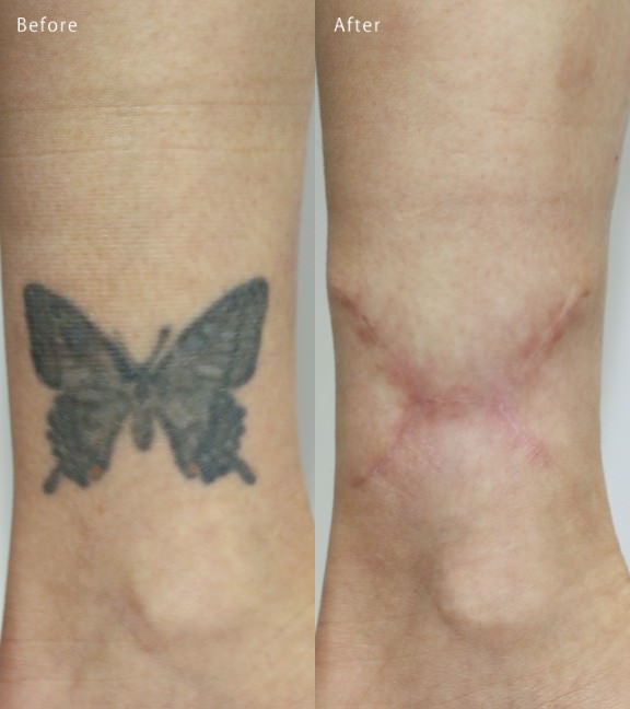 切除術 Before After