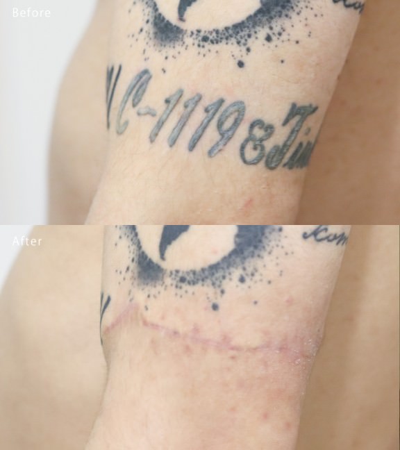 切除術 Before After