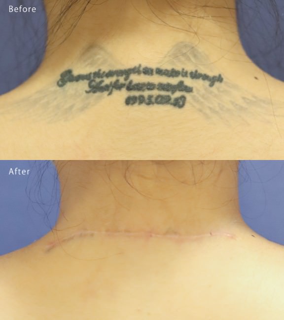 切除術 Before After