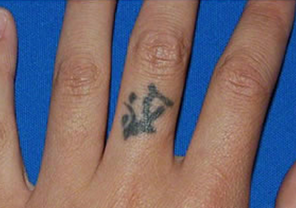 手の指 検索結果 タトゥー 刺青 除去なら東京イセアクリニック銀座院