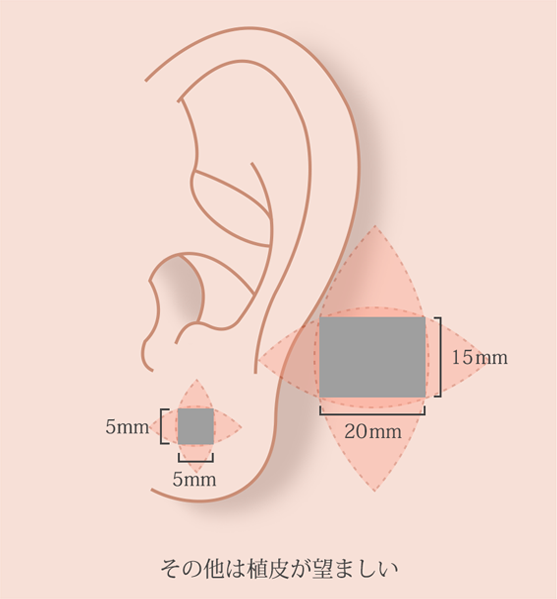 耳のタトゥー除去