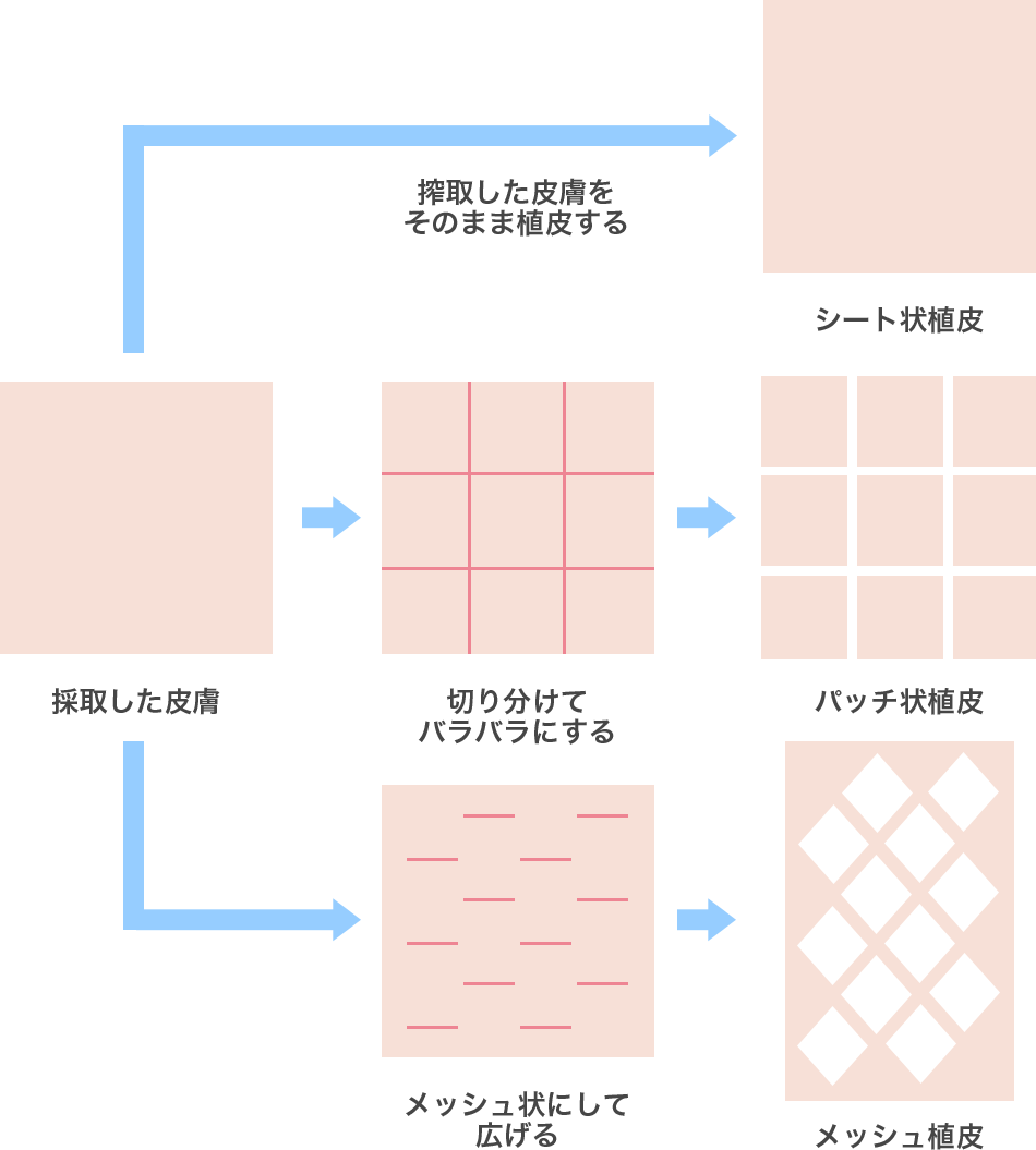 植皮術の種類