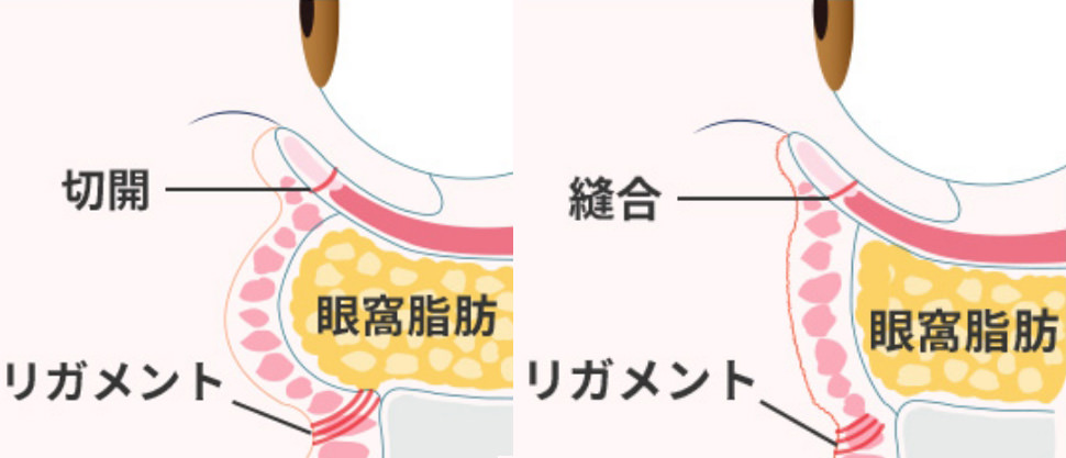 リガメント外し