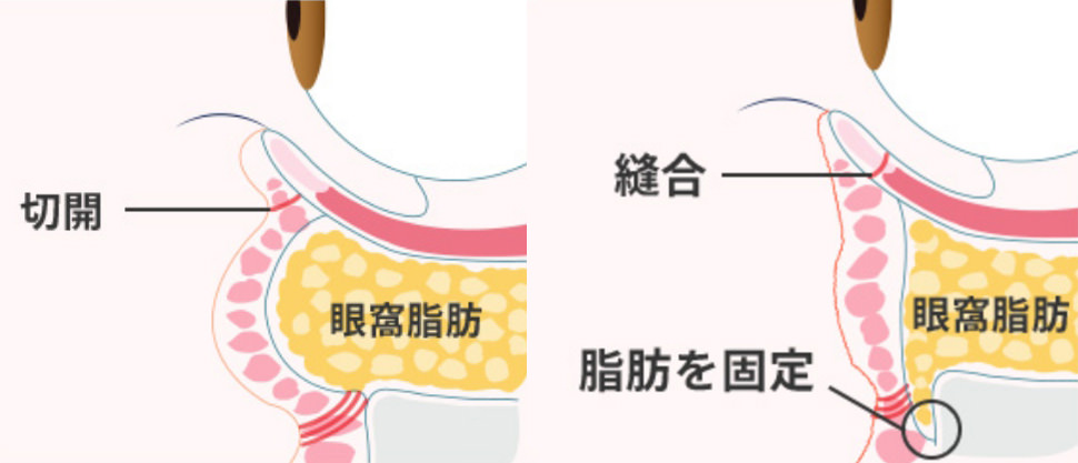 表ハムラ