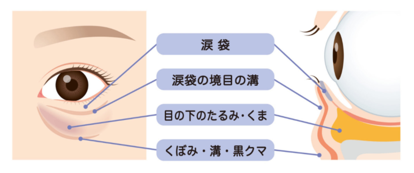 目の下のクマ・たるみ取り治療とは