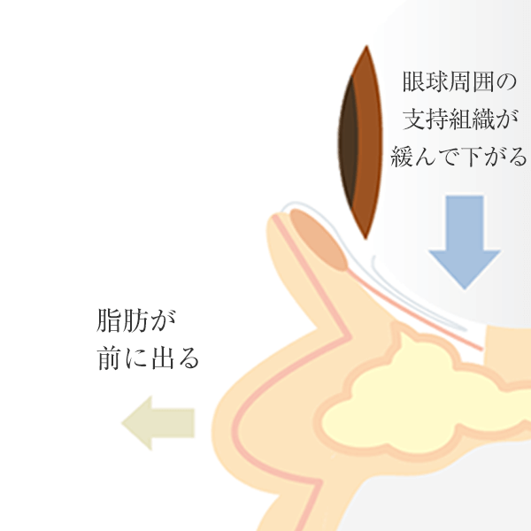 なぜ眼窩脂肪が膨らんでしまうのか?