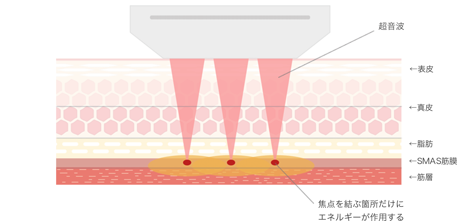 皮膚断面図とウルセラの作用