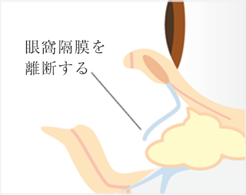 筋肉と隔膜を剥離します