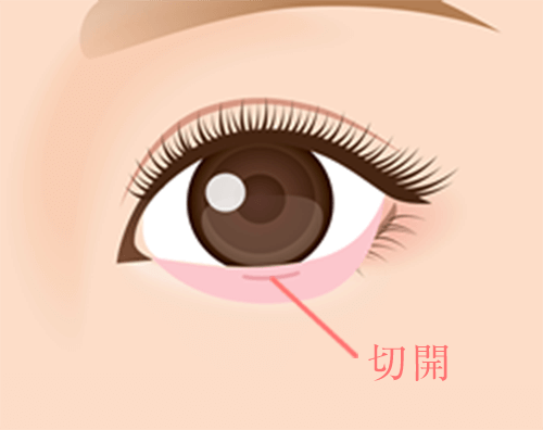 下瞼の裏側を切除