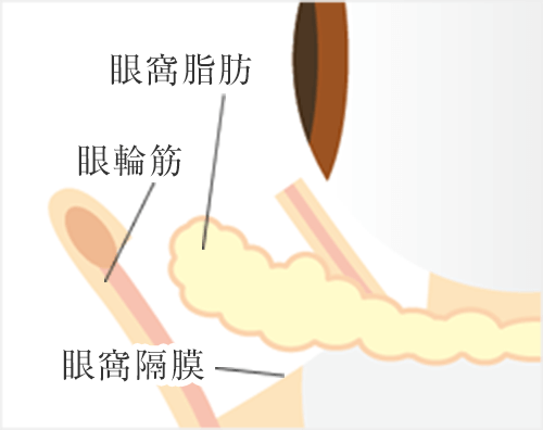 眼窩脂肪を引き出す