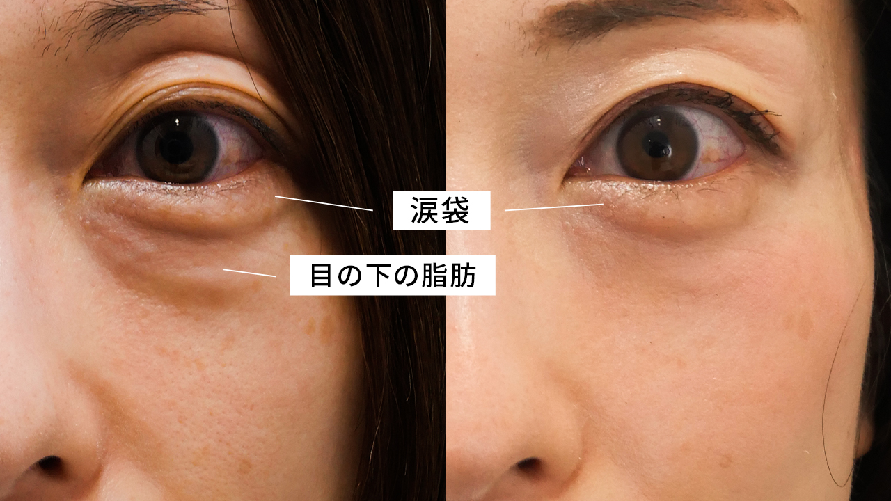 下眼瞼脱脂術で涙袋はなくならない 目の下のたるみと涙袋の関係を解説 ドクターブログ 目の下のたるみ取りなら東京イセアクリニック