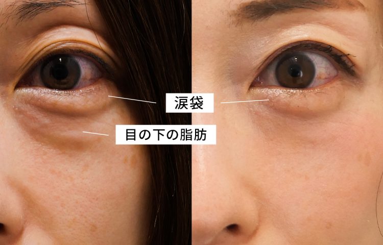 下眼瞼脱脂術で涙袋はなくならない　目の下のたるみと涙袋の関係を解説