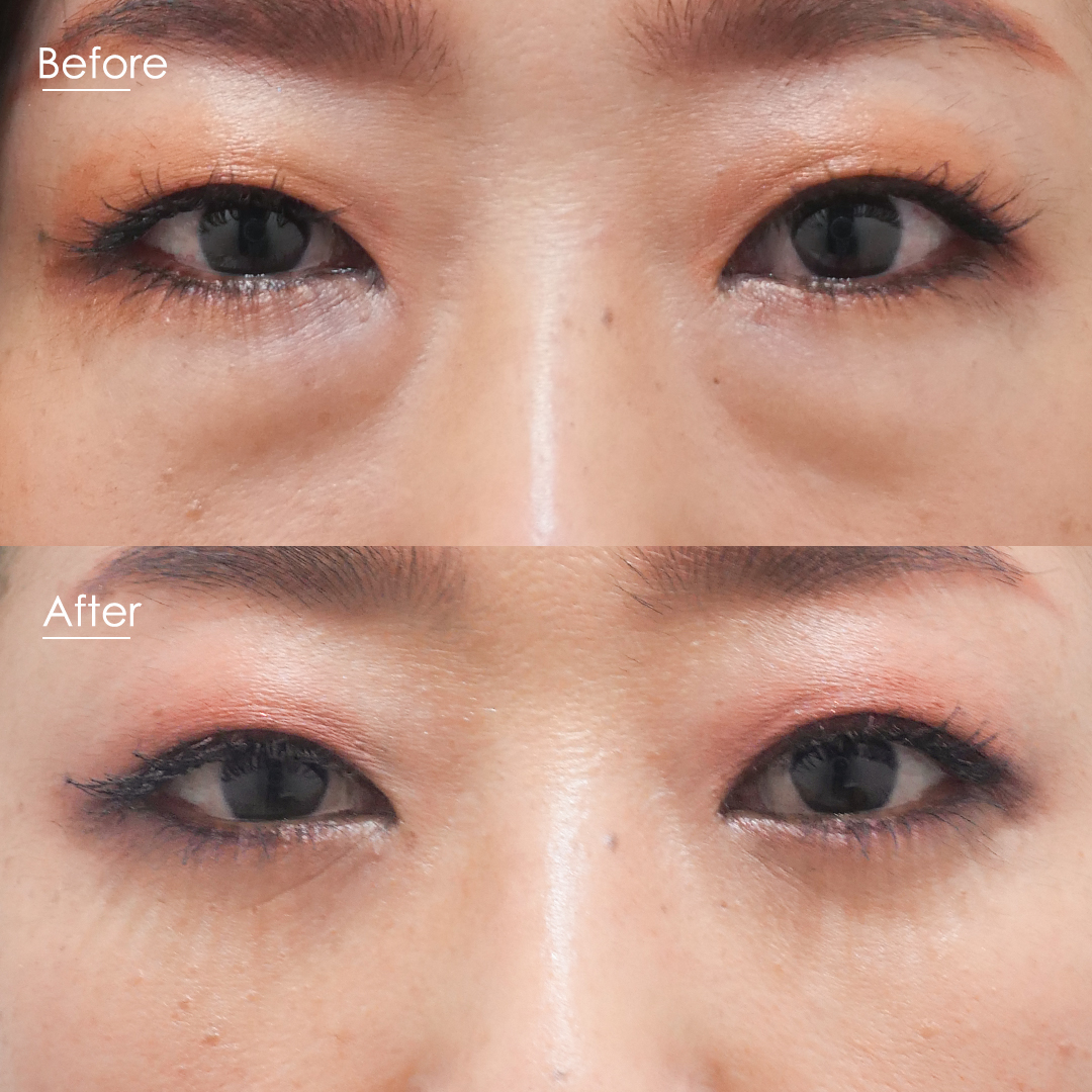 眼窩脂肪を減らす方法とは 比較して解説 ドクターブログ 目の下のたるみ取りなら東京イセアクリニック