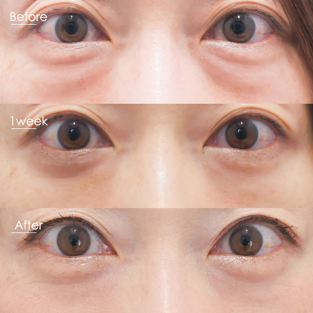 眼窩脂肪を減らす方法とは 比較して解説 ドクターブログ 目の下のたるみ取りなら東京イセアクリニック 眼窩脂肪を減らす方法とは 比較して解説 ドクターブログ 目の下のたるみ取りなら東京イセアクリニック