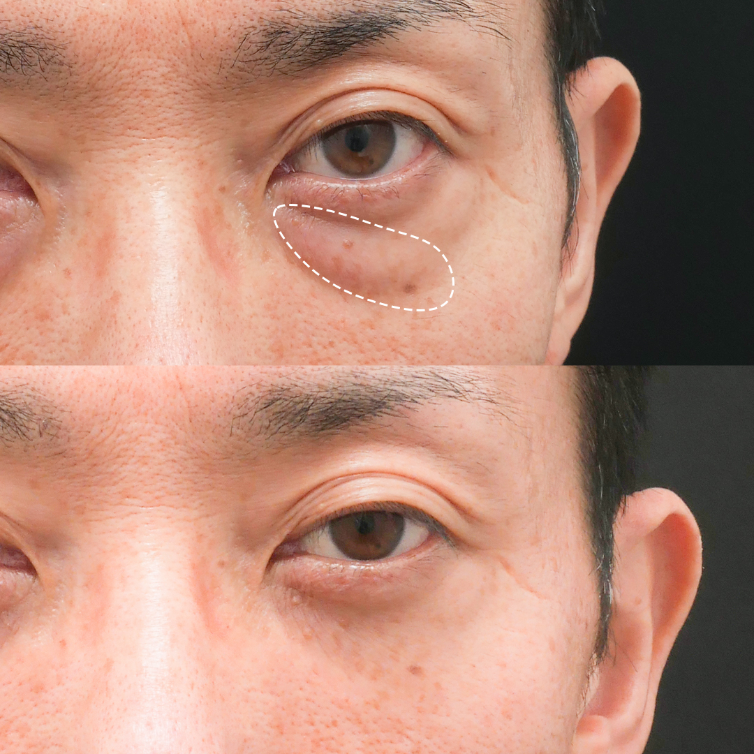眼窩脂肪を根本的に減らす方法を3つご紹介 ドクターブログ 目の下のたるみ取りなら東京イセアクリニック