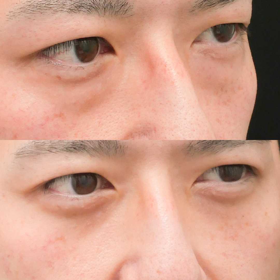 下眼瞼脱脂のみで十分なケースとは 医師が違いを解説 ドクターブログ 目の下のたるみ取りなら東京イセアクリニック